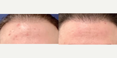 Patient  treated with AviClear - Our bespoke acne solutions combine AviClear & other laser treatments, soothing infrared light therapy, & an exclusive range of at-home skincare products.Say goodbye to stubborn acne & hello to your clearest, most radiant skin!