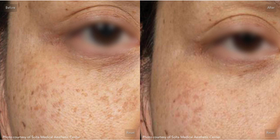 Man treated with Clear and Brilliant - Man treated with Clear and Brilliant