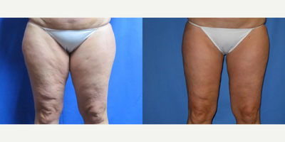 45-54 year old woman treated with Laser Liposuction - This is a 52-year-old woman who is a regional manager with her company and travels throughout Washington, Oregon, Idaho, Montana, and the Western U.S. for her job. She is a frequent flyer and constantly on the go. She has tried exercise and dieting but the inches just would not come off. She wanted to treat excess fat and she has become frustrated with the appearance of her cellulite. She was interested in Smartlipo because of the quick recovery and her ability to return to work within a few days of the procedure. She was also fearful of general anesthesia and was only willing to perform a minimally invasive procedure that would address her saddlebags, the shape of her buttocks, and inner thighs, and improve the appearance of her cellulite. Cellulite is a difficult problem to treat. The dimpled appearance arises from the small connecting ligaments between the skin and muscle. This creates a mattress button effect with the resulting appearance of cellulite. Cellulite is extremely common affecting more than 90% of all women. An added benefit of laser lipolysis is the improvement in the appearance of cellulite. The patient had a total of 1.6 liters of fat removed from the inner and outer thigh and the banana roll (fatty accumulation just below the gluteal crease on the upper posterior thigh). She took only 2 pain pills the night of the procedure. She transitioned the next day to Tylenol and Advil only. These photos show several views before and 6 weeks after Smartlipo laser liposuction. Note the improved appearance of the cellulite throughout. The patient went on the have Smartlipo performed on her abdomen and flanks (3 liters) as a separate procedure only 9 days later.