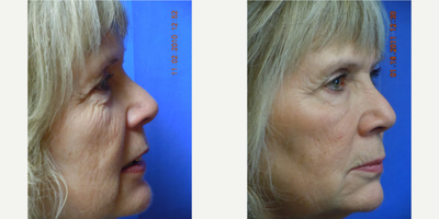 55-64 year old woman treated with Juvederm, Laser Resurfacing - This patient is a 62-year-old woman from North Idaho concerned about the typical changes of the aging face which include: wrinkles, texture changes, fine lines, volume loss, laxity, and facial drooping of the cheeks and at the corners of the mouth. She also has concerns about love handles and varicose veins. All of these issues were addressed and the patient was evaluated with a Visia computerized digital complexion analysis. The most striking issue was the loss of volume in the midface and a tear trough deformity which typically causes our patients to complain of either dark circles under the eyes or bags under the eyes. Treatment recommendations consisted of CO2 fractional resurfacing, dermal fillers, and Smartlipo body sculpting for the muffin tops. Choosing to get the most bang for the buck, we agreed on facial rejuvenation and volume restoration with JUVDERM Ultra XC and JUVEDERM Ultra Plus XC, which is formulated with the numbing medication Lidocaine for more comfort during the procedure. We placed a total of 6 syringes of the dermal filler in the tear troughs, midface, and at the corners of the mouth (oral commissure). As you can see, this created a fresher, more rested, and younger look without looking artificial or plastic. Many of our dermal filler patients are thrilled with the immediate improvement that fillers create in a procedure that is comfortable for them and takes less than an hour.