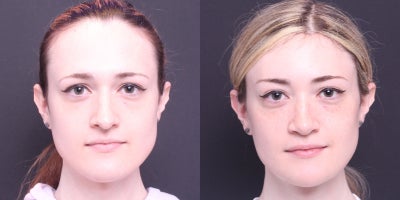 25-34 year old transgender woman treated with Facial Feminization Surgery - browlift, brow bone reduction, hairline advancement, rhinoplasty, thyroplasty, mandible/chin contouring, submental liposuction