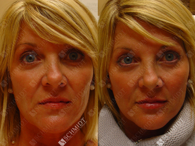 Woman treated with Juvederm - Woman treated with Juvederm