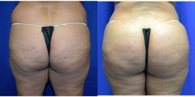 45-54 year old woman treated with Brazilian Butt Lift - 45 year old female 6 weeks after a Brazilian Butt Lift. Her height is 5 feet 4 inches and weight 179lbs. She has two children. She had vaser liposuction to her abdomen and back with 4300cc's of aspirate removed. She had 600cc's of fat placed in each buttock.