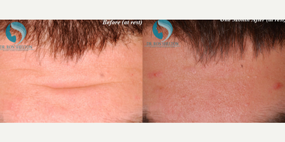 25-34 year old man treated with Fraxel Repair - He was very unhappy to have such deep forehead lines prior to the smoothening that Botox accomplished.