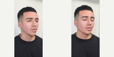 25-34 year old man treated with Chin Filler - Jawline and chin filler
