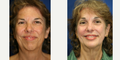Chemical Peel 3 (front view) - This is a 59 year old female. She had weight loss surgery and lost 115 lbs. She was not happy with the appearance of her chin and brow. She underwent a chin implant, brow lift, and TCA chemical peel on her face.