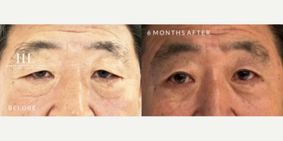 76 year old man treated with Eyelid Surgery - 76 year old man treated with upper Eyelid Surgery. Pre-op, patient is complaining of droopy upper eyelids interfering with his vision. Patient is shown before and 6 months post-op.