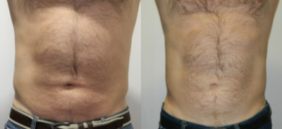 45-54 year old man treated with i-Lipo - 8 ilipo sessions to abdomen