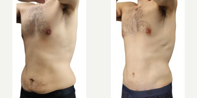 Man treated with Tummy Tuck, Liposuction - Abdominoplasty with Liposuction to the Hips and Flanks