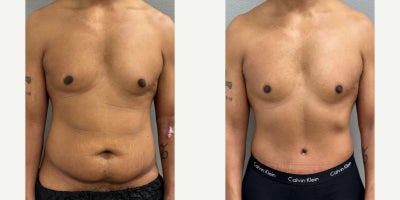 35-44 year old man treated with Male Tummy Tuck - 38 year old male s/p tummy tuck performed in our on site AAAA certified operating suite.