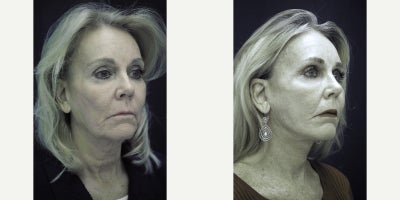 55-64 year old woman treated with Neck Lift - This patient had an extended neck lift with all incisions carefully placed behind the ear and into the lower hairline. Only has a 2 week recovery. Most patients can go back to work after 10 days with only mild bruising.