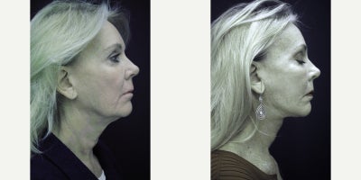 55-64 year old woman treated with Neck Lift - This patient had an extended neck lift with all incisions carefully placed behind the ear and into the lower hairline. Only has a 2 week recovery. Most patients can go back to work after 10 days with only mild bruising.