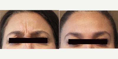 45-54 year old woman treated with Botox, Dysport, Jeuveau, Xeomin - Botox injection for treatment of crow's feet & lines & wrinkles in forehead & between eyebrows (can also be done with Dysport, Jeuveau or Xeomin)