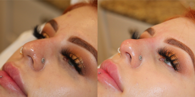 18-24 year old woman treated with Nonsurgical Nose Job - This female in her 20s, presented desiring nasal reshaping using dermal fillers. She does not want a surgical rhinoplasty. Using 1 mL (one syringe) of Restylane L, made by Galderma, I was able to reshape her nasal bridge and nasal tip to a much more aesthetically pleasing appearance. The photos are before and immediately following the injection.