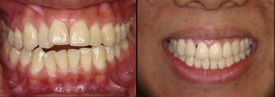 Braces to treat openbite and crowding - 
	Tough case to treat, took 1+ year.

