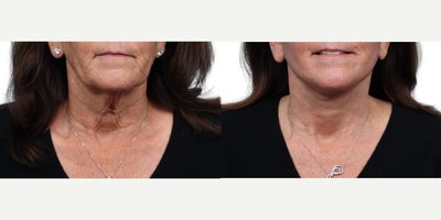 61 year old woman treated with Facelift, CO2 Laser - This 61-year-old was concerned with aging eyes and overall facial changes, including skin laxity and fine lines. She underwent a lower blepharoplasty, facelift, and full-face CO laser treatment, resulting in a smoother, rejuvenated, and more youthful appearance.