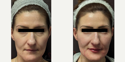 35-44 year old woman treated with Liquid Facelift, Juvederm, Voluma, Volbella - Liquid Facelift with 4D Under Eye Lift (removal of dark circles under eyes), cheek restoration and lip augmentation with Belotero, Restylane, Volbella and Voluma