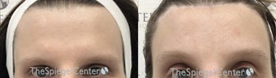 25-34 year old transgender woman treated with Facial Feminization Surgery - 25-34 year old transgender woman treated with Facial Feminization Surgery