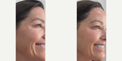 Woman treated with SkinCeuticals - Woman treated with SkinCeuticals