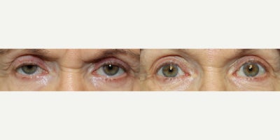 65-74 year old woman treated with Bilateral Internal Ptosis Repair - 65-74 year old woman treated with Bilateral Internal Ptosis Repair