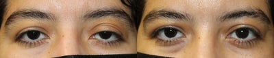 35-44 year old woman treated with Internal Ptosis repair on Left Side. - 35-44 year old woman treated with Internal Ptosis repair on Left Side.