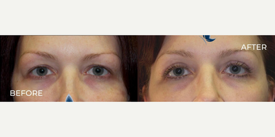 Woman treated with Eyelid Surgery - Woman treated with Eyelid Surgery