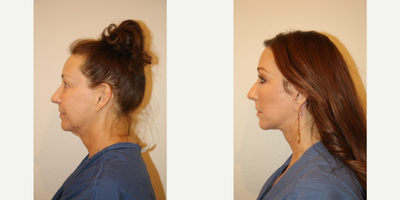 55-64 year old woman treated with Neck Lift - This is a 60 year old female shown before and after undergoing a lower face and neck lift, upper eyelid blepharoplasty as well as facial fat grafting.