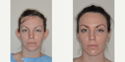 Woman in her late 20's treated with Ear Surgery by Dr. Anthony Bared - Before and after otoplasty for protruding ears.  Dr. Bared uses a cartilage-sparing technique in otoplasty to preserve the cartilage and allow for natural-appearing results.  The natural folds of the ears which are absent in cases of protruding ears are recreated through an otoplasty to setback the ears.
