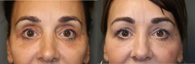 Pan Facial Rejuvenation - Upper and lower lid filler, temple and jawline rejuvenation.