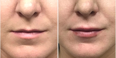 25-34 year old woman treated with Juvederm - Shown before and immediately after injection of one syringe of Juvederm upper and lower lips