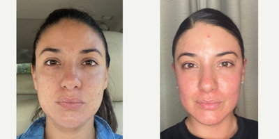 FIRST STEPS TOWARDS BETTER SKIN WITH LASER COMBO - My patient wanted to start her journey to soften her acne scars and we did a big treatment as the first step.  At consultation we discussed that this would take many treatments to get her to where she wanted.  She has deep ice pick scars and some active breakouts.  We did not only want to address her scars but took into account the early signs of aging such as the eyelids, neck, and volume lossANTI AGING AND ACNE COMBO  TCA Cross Sculptra  CO2 Laser Plasma Pen TAG A BEST FRIEND WHO MAY WANT THIS TREATMENT 