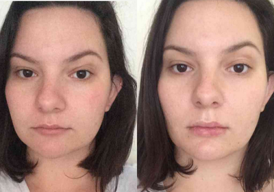 18-24 year old woman treated with Restylane Silk - Restylane silk to lips.