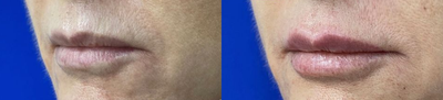 Woman treated with Restylane Kysse - Woman treated with Restylane Kysse