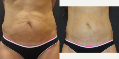 45-54 year old female treated with ThermiTight - This Asian American female patient received a ThermiTight treatment to the central abdominal area doing 1 treatment, superficial and deep passes during the same procedure. She is 3 months out from the day of procedure in the After picture.