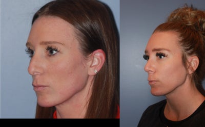 25-34 year old woman treated with Rhinoplasty - Rhinoplasty with Chin Implant