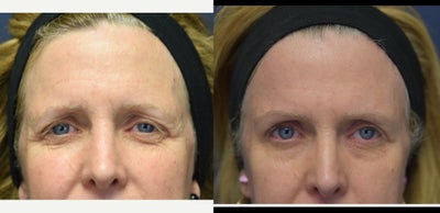 45-54 year old woman treated with Brow Lift - This patient was unhappy with her tired appearance, and decided to have a mini brow-lift in the office under local sedation.