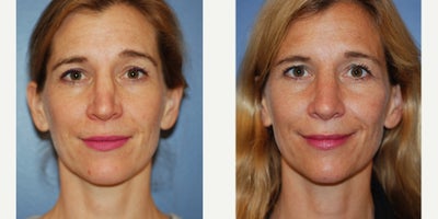 35-44 year old woman treated with Revision Rhinoplasty - 40 year old woman having rhinoplasty