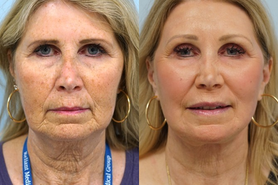 55-64 year old woman treated with Fractional Laser - Fractional CO2 laser is used to target and fade brown spots and resurface fine dermal wrinkling. She also had a brow lift and facial fat grafting. All procedures were done in one setting.