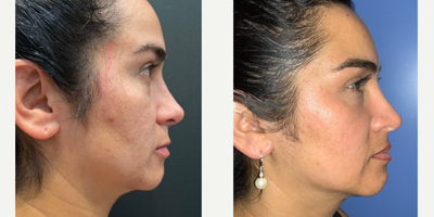 Woman treated with Mini Facelift - Mini Facelift Before + After. I always say, Subtle change can make the biggest difference! A mini facelift can help achieve a more youthful look and tightened look to take years off of your appearance!