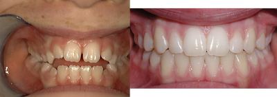 Open bite case - 
	Open bite case treated with braces.
