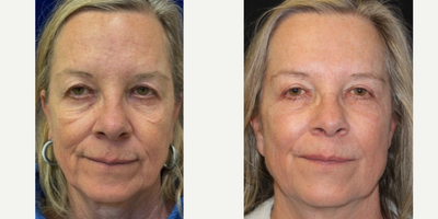 55-64 year old woman treated with Sylfirm X - 60 year old woman treated with Sylfirm X