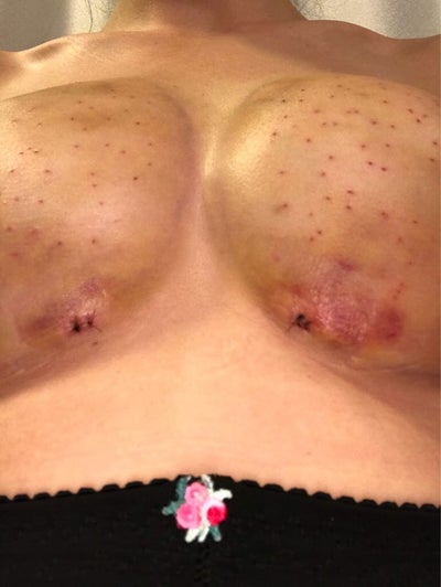 Bednar Cosmetic on X: Here's a Before & After of a Fat Transfer to the  breast patient just 2 months post op. Yep. She's very happy with her  results. And, Nope. She