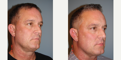 45-54 year old man treated with Skin Tightening - Patient not interested in surgical facelift. 6 non-invasive treatments of Evoke performed on lower face and neck.