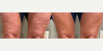 Woman treated with Forma - 6 treatments of Forma and BodyFX