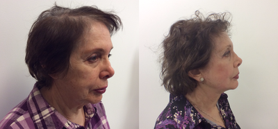 65-74 year old woman treated with Facelift - facelift