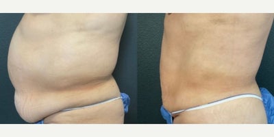 Woman treated with Renuvion - Woman treated with Renuvion