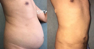 Man treated with Smart Lipo - Man treated with Smart Lipo