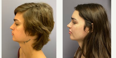 18-24 year old woman treated with Adam's Apple Reduction, Forehead Reduction, Brow Lift, Rhinoplasty, Septoplasty, Cheek Augment - This is a young lady who underwent forehead feminization surgery, septorhinoplasty, and cheek implants.