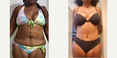 25-34 year old woman treated with Tummy Tuck, Liposuction, Brazilian Butt Lift - Excellent outcome after full body intense liposuction including abdomen, waist, laterals, upper and lower back plus DOMINICAN BUTT LIFT by Mallol getting better volume, contour and butt projection.