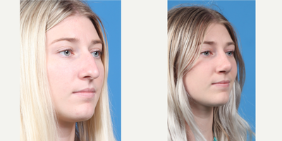 18-24 year old woman treated with Septoplasty - Septo-Rhino plasty